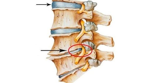 zdrav in poškodovan hrbtenični disk z cervikalno osteohondrozo