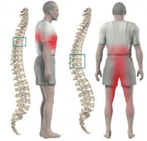 poškodbe hrbtenice in bolečine v torakalni osteohondrozi