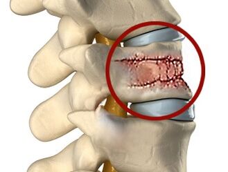 Vzroki za bolečine v hrbtu so lahko bolezni hrbtenice in medvretenčnih ploščic. 