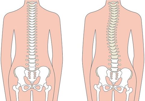 Bolečina v križu zaradi deformacije hrbtenice, kot je skolioza