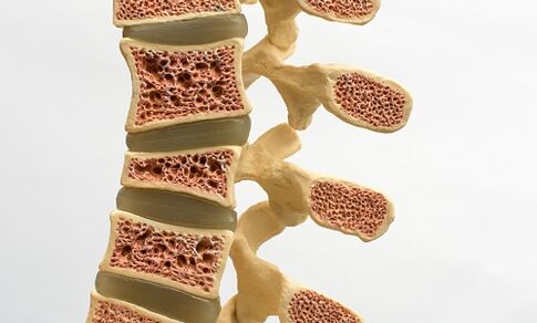 Osteoporoza je eden od vzrokov za bolečine v spodnjem delu hrbta
