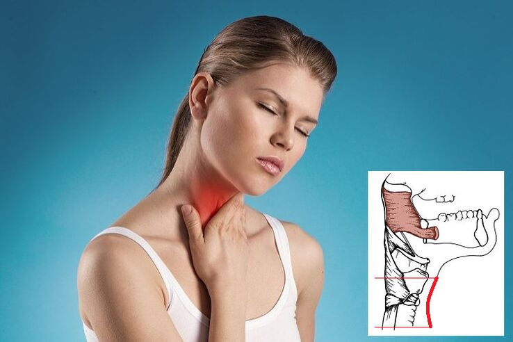Bolečina v grlu s cervikalno osteohondrozo zaradi stiskanja živca