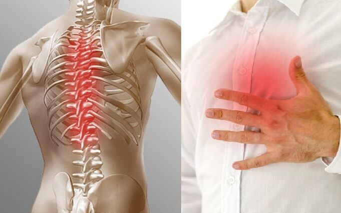 Torakalna osteohondroza in bolečine v prsih