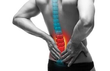 Osteohondroza je bolezen hrbtenice