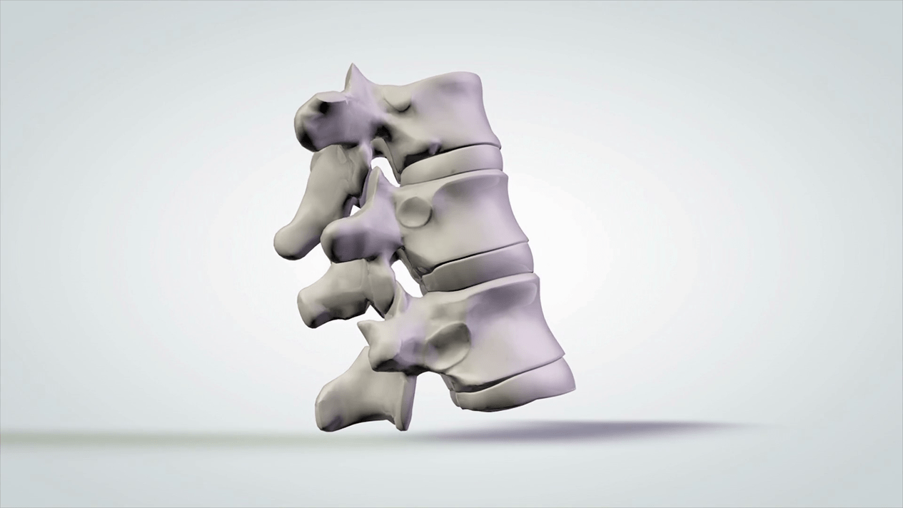 poškodbe hrbtenice zaradi cervikalne osteohondroze