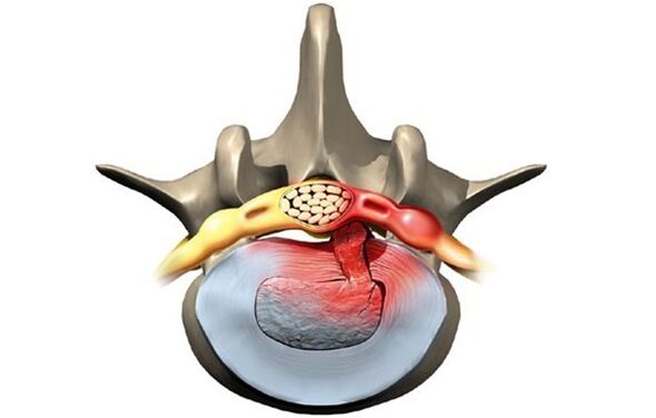 vretenca, prizadeta zaradi osteohondroze