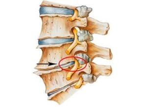 Znaki in simptomi osteohondroze