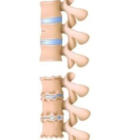 vzroki osteohondroze